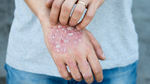 How to deal with psoriasis