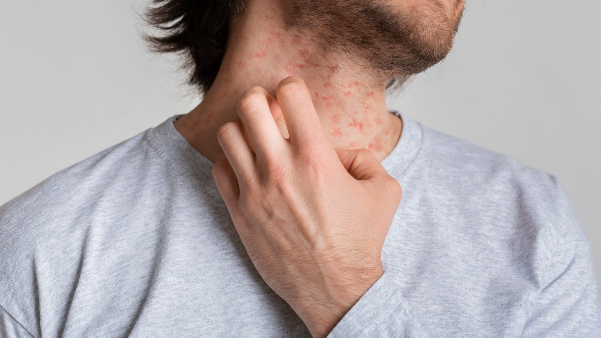 Eczema Causes, Triggers, and Solutions: Answers to Your 12 Most Itching Questions