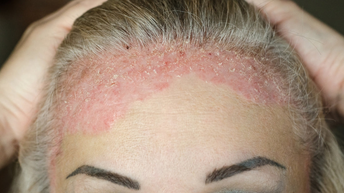 Managing Psoriasis: Tips from Skincare to Wellness