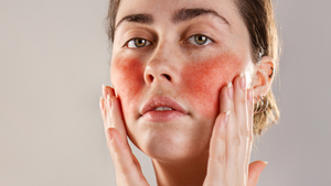 Understanding Rosacea: Skincare Tips & Management