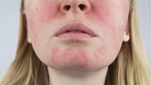 Rosacea Wellness Plan