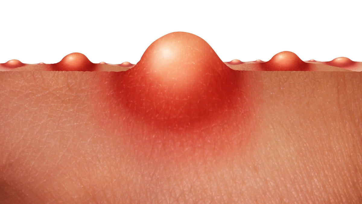 Unlocking Clear Skin: Acne Awareness Month Tips & Product Spotlight